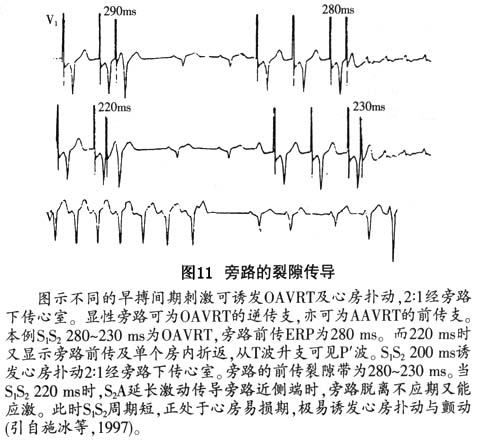 阵发性室上性心动过速的治疗_阵发性房性心动_阵发性室性心动过